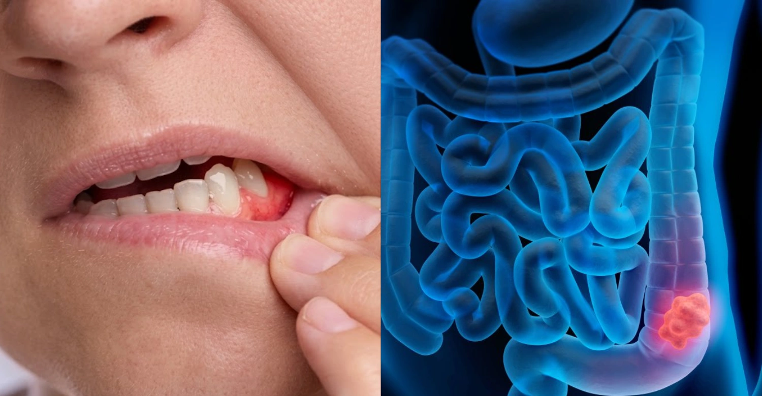 Gum Disease and Colon Cancer Inblog
